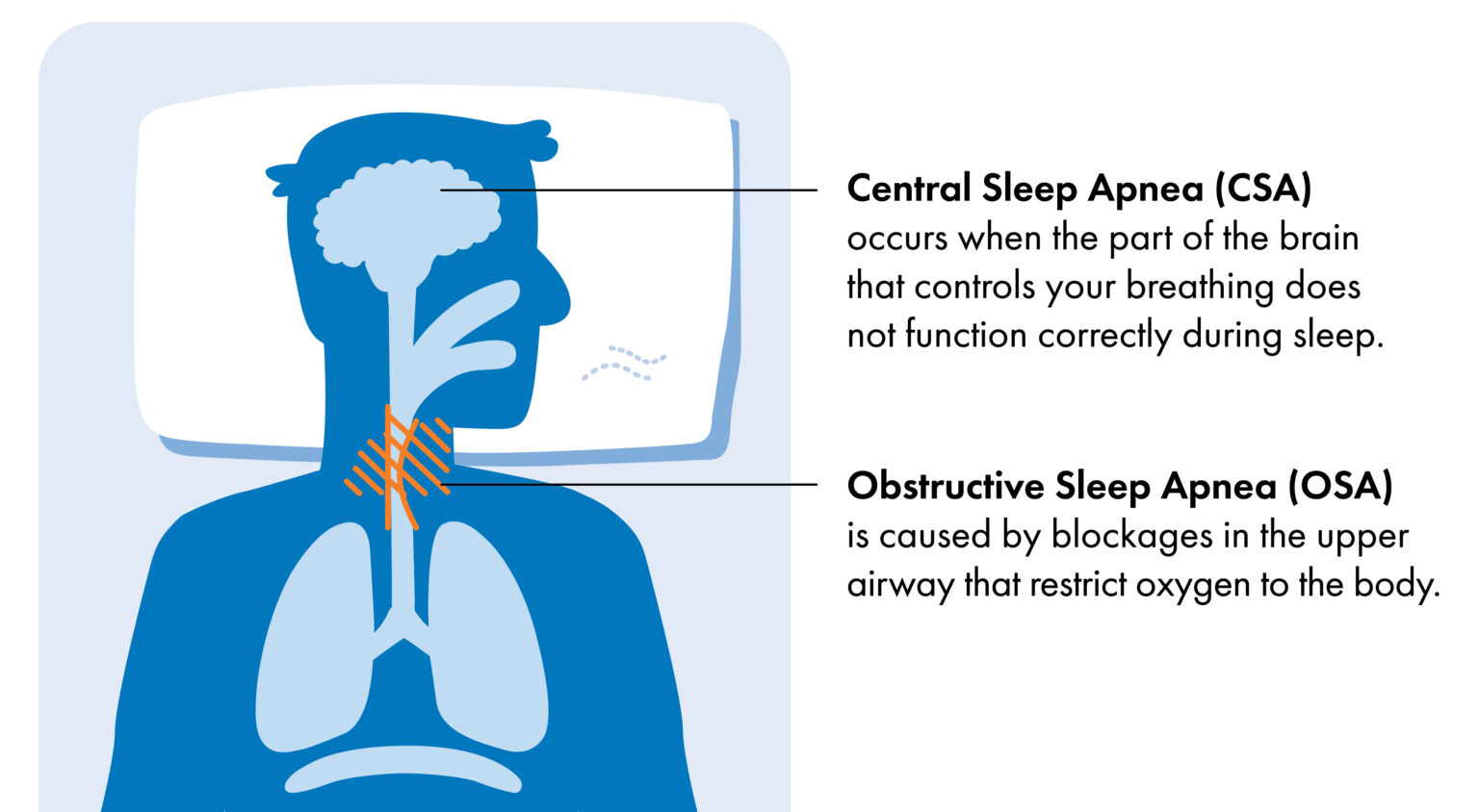 Central Sleep Apnea Csa Remed System