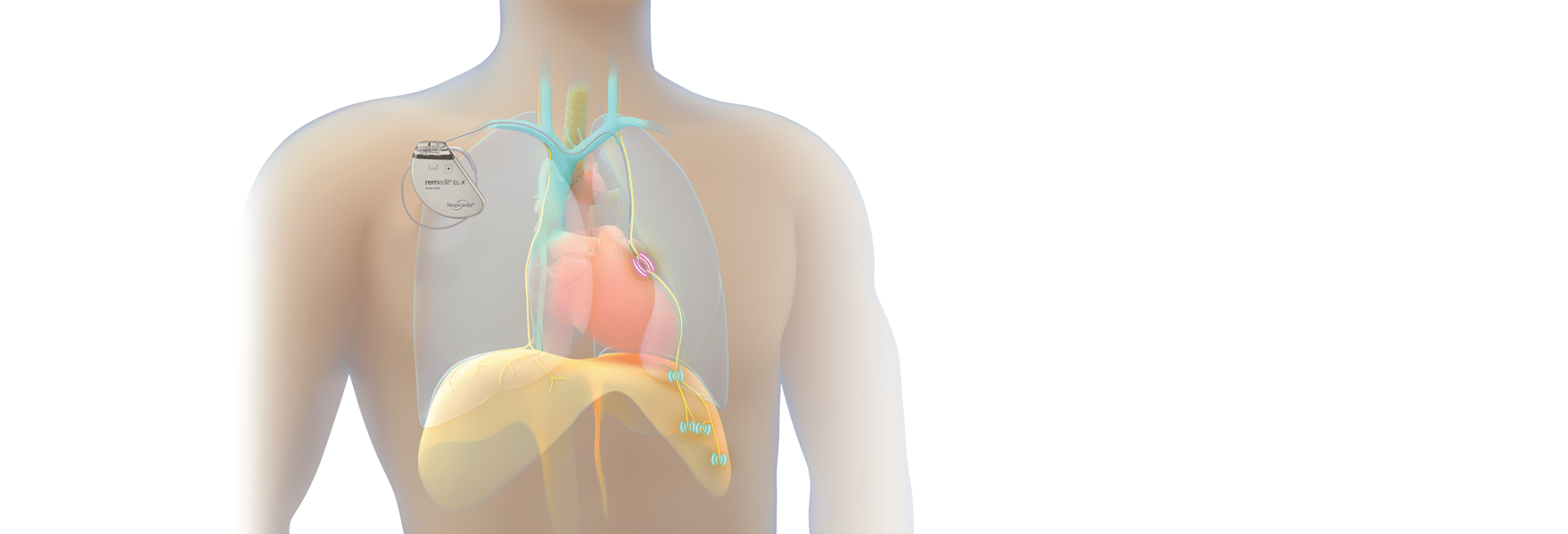 remede EX-L system with heart and lungs
