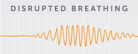 Disrupted breathing chart due to Central Sleep Apnea