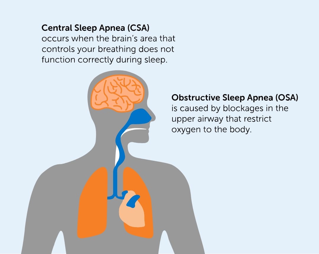 Centra Sleep Apnea vs Obstructive Sleep Apnea graphic
