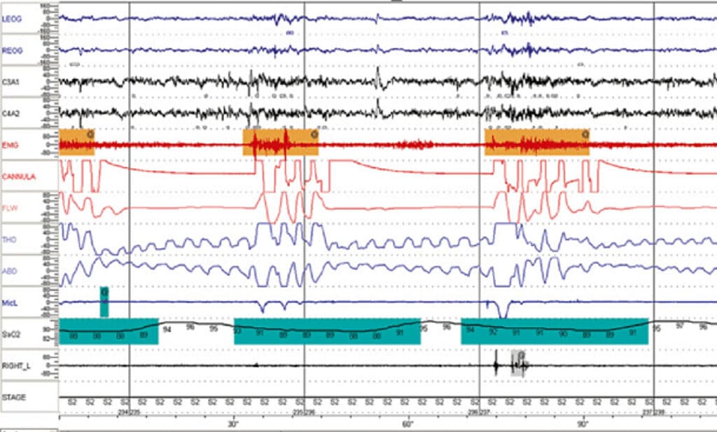 Understanding Your In-Lab Sleep Study Results | remedē System